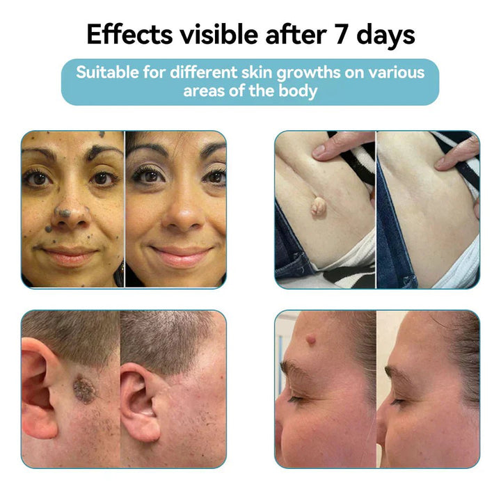 ✨QIAWI™ All-In-One CO₂ Laser Eraser Pen | Removes Moles, Warts, Skin Flaws & Pigmentation