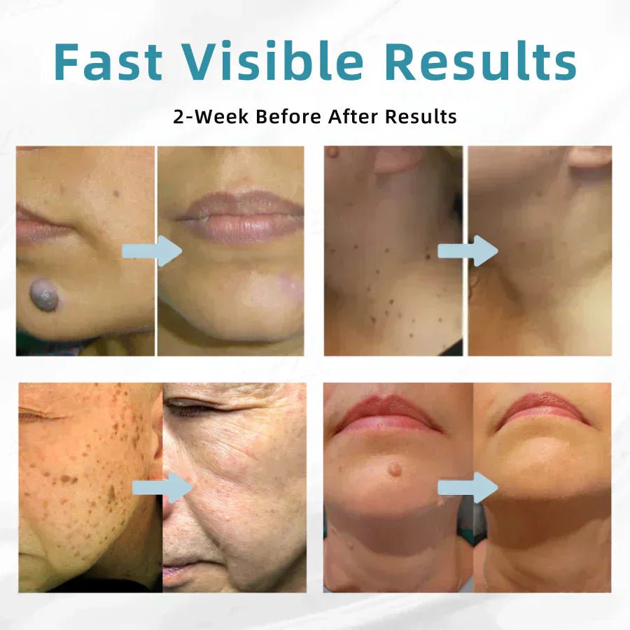 ✨QIAWI™ All-In-One CO₂ Laser Eraser Pen | Removes Moles, Warts, Skin Flaws & Pigmentation
