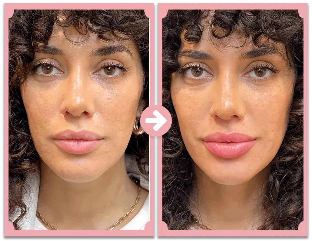 KISSFORM™ - Titanium Lips Booster & Serum - aarwaan